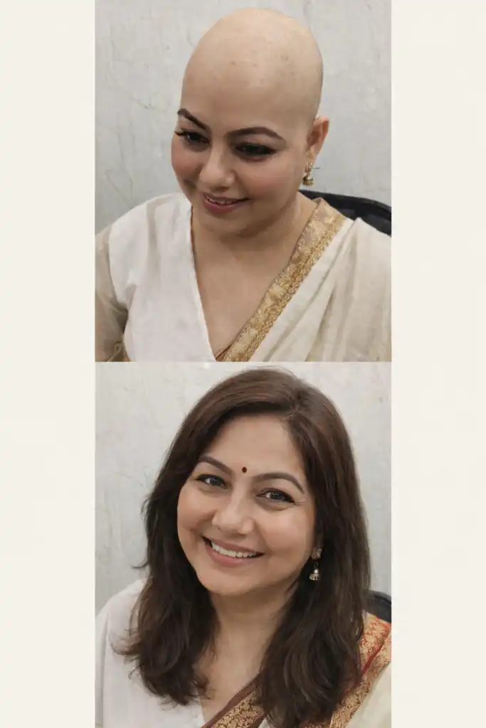Chemotherapy wigs at Arogyam Guwahati