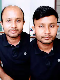 Natural hair patch for men in Guwahati - Arogyam Clinic.