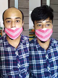 Natural hair patch for men in Guwahati - Arogyam Clinic.