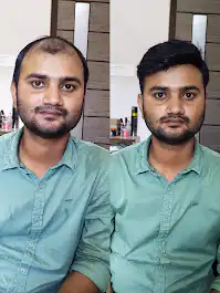 Natural hair patch for men in Guwahati - Arogyam Clinic.