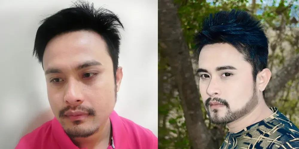 Beard Transplant 2500 grafts | French Type Beard | 4 months Post Op