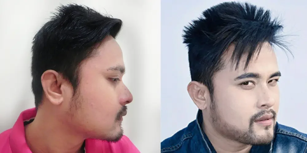 Beard Transplant 2500 grafts | French Type Beard | 4 month Post Op