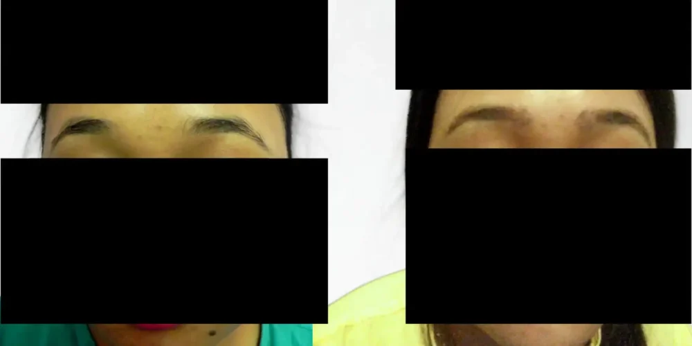 Eyebrow Transplant with Reduction of Gap between Eyebrows