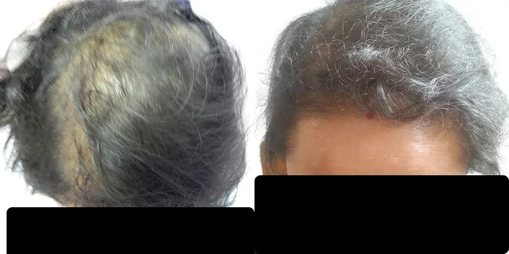 Female Pattern Baldness | Transformation with 2000 grafts | 6 months Result
