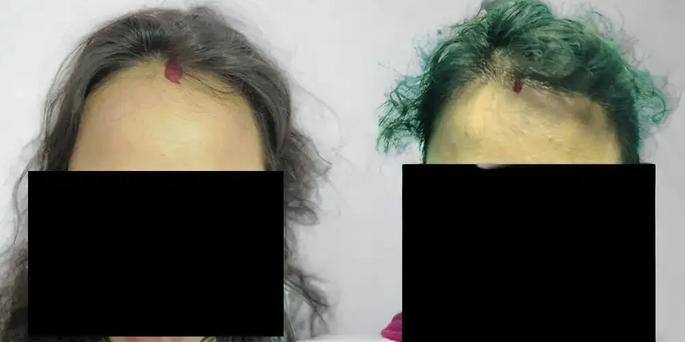 Female Hairline Lowering | 1200 grafts | 5 months
