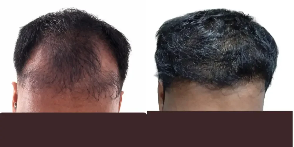 Repair Transplant of Previous Unsatisfactory Procedure Done Elsewhere | 2500 Grafts | 4 Months Result